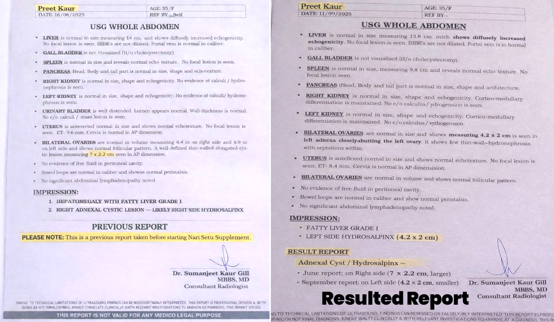 Real Result Story: Ovarian Cyst Reduction & Hormonal Balance with NariSetu ayurvedic women's health supplement– Romalia Ayurveda